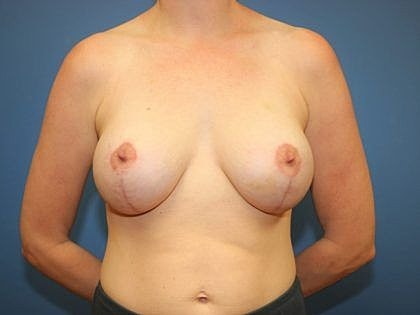 Medical image of breast augmentation results