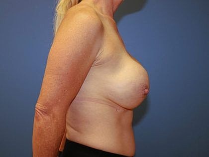 Profile view of woman's breast anatomy.