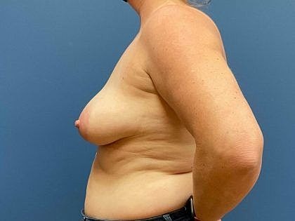 Female side profile against blue background.