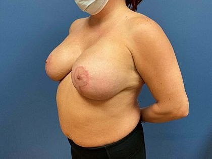 Post-surgery patient with protective mask, side view.