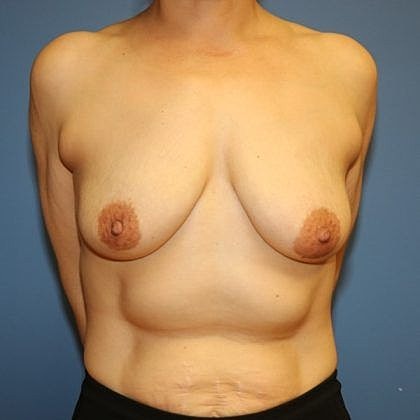 Female torso with visible anatomy details.