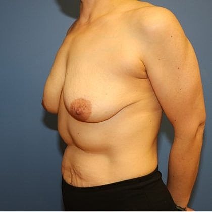 Side profile of a female torso.