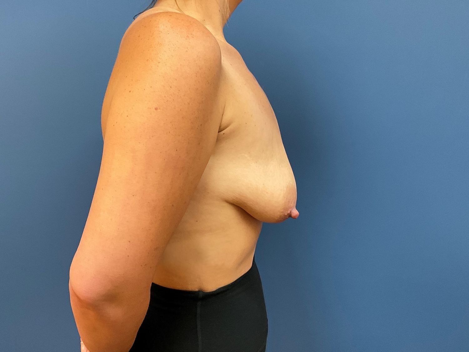 Breast Lift With Implants Before & After