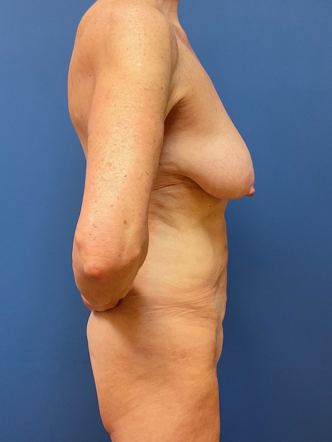 Breast Lift With Implants Before & After