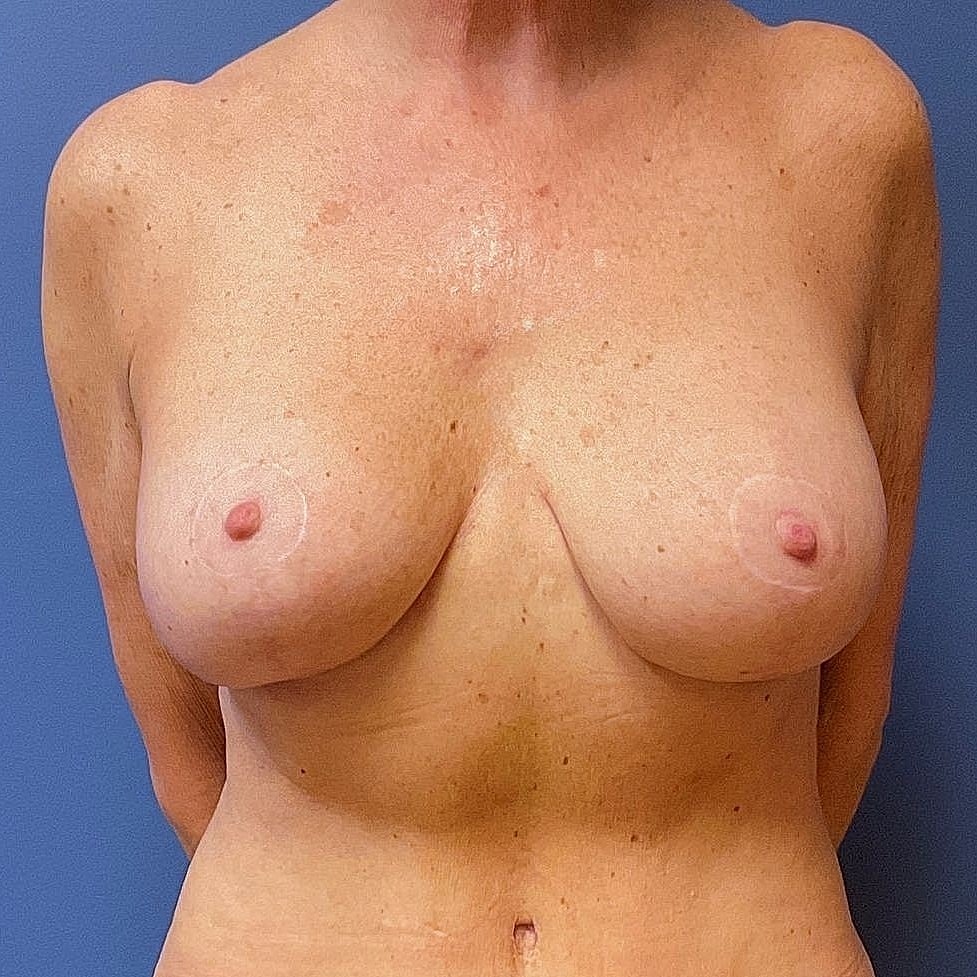 Breast Lift With Implants Before & After