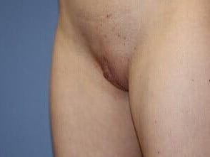 Labiaplasty Before & After