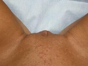 Labiaplasty Before & After