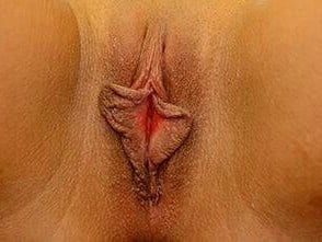 Labiaplasty Before & After