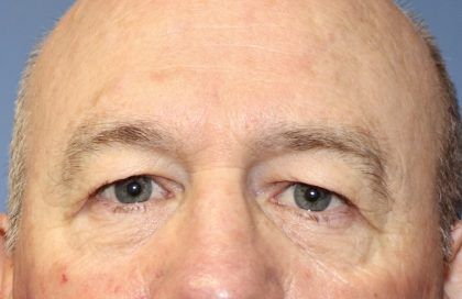 Eyelid Lift Before & After