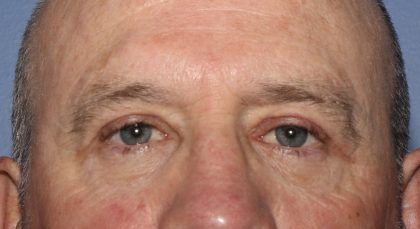 Eyelid Lift Before & After