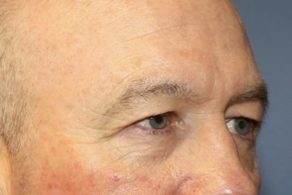 Eyelid Lift Before & After