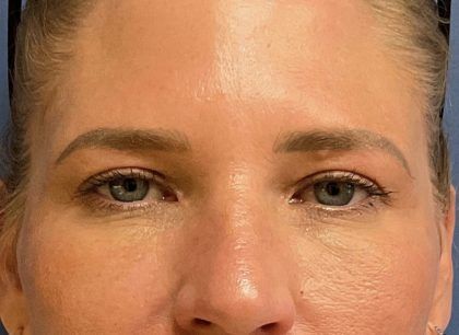 Eyelid Lift Before & After