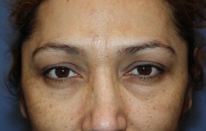 Eyelid Lift Before & After