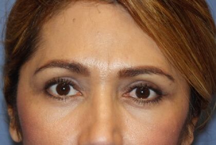 Eyelid Lift Before & After
