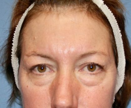 Eyelid Lift Before & After