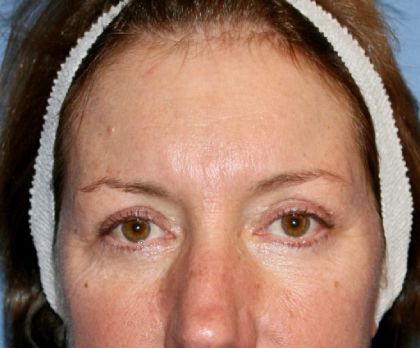Eyelid Lift Before & After
