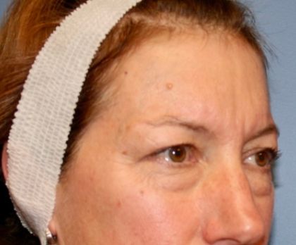 Eyelid Lift Before & After