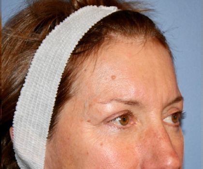 Eyelid Lift Before & After