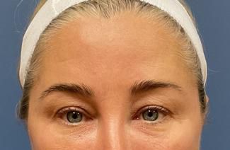 Eyelid Lift Before & After