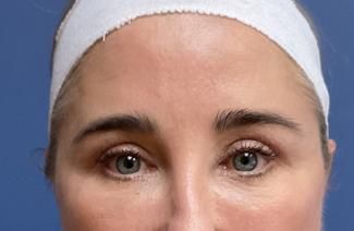 Eyelid Lift Before & After