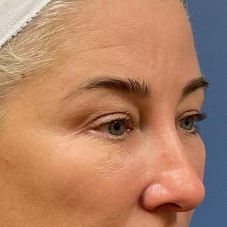 Eyelid Lift Before & After