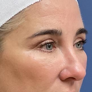 Eyelid Lift Before & After