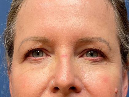 Eyelid Lift Before & After