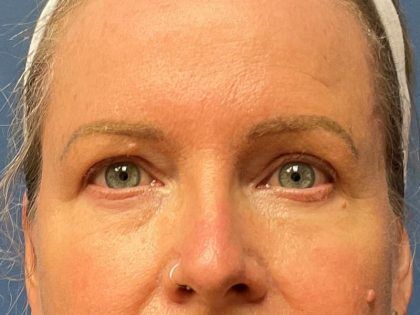 Eyelid Lift Before & After