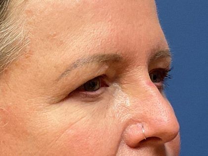 Eyelid Lift Before & After