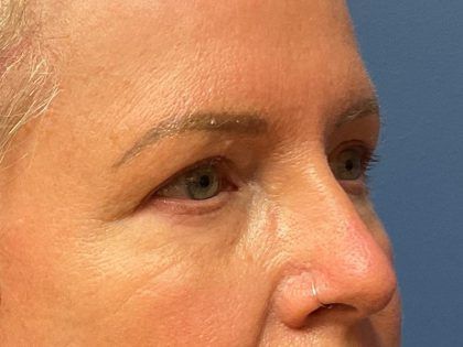 Eyelid Lift Before & After