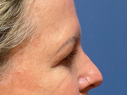 Eyelid Lift Before & After