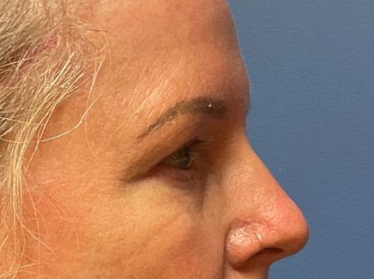 Eyelid Lift Before & After