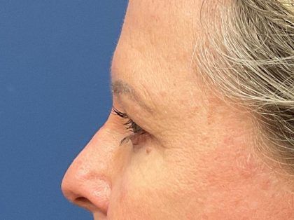 Eyelid Lift Before & After