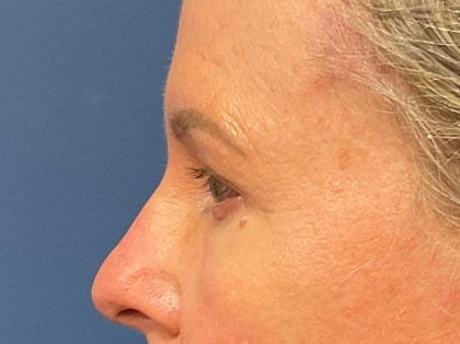 Eyelid Lift Before & After