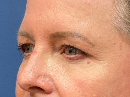 Eyelid Lift Before & After