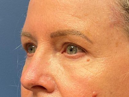 Eyelid Lift Before & After