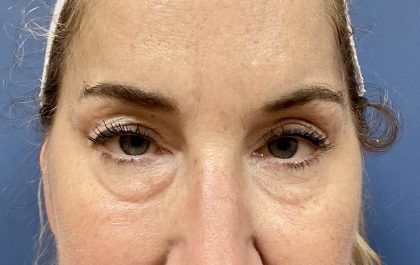 Eyelid Lift Before & After