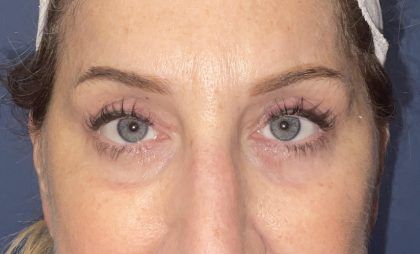 Eyelid Lift Before & After