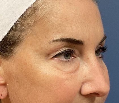 Eyelid Lift Before & After