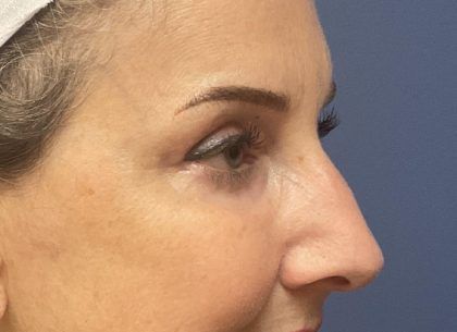 Eyelid Lift Before & After