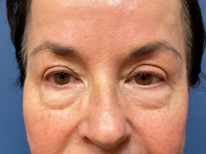 Eyelid Lift Before & After