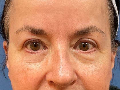 Eyelid Lift Before & After