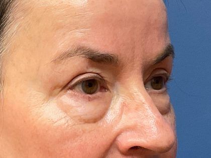 Eyelid Lift Before & After