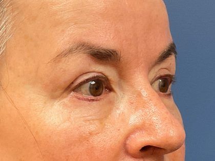 Eyelid Lift Before & After