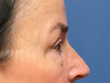 Eyelid Lift Before & After
