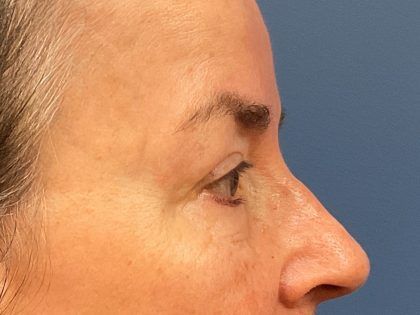 Eyelid Lift Before & After