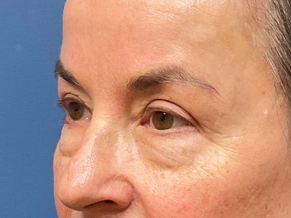 Eyelid Lift Before & After
