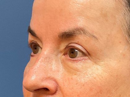 Eyelid Lift Before & After