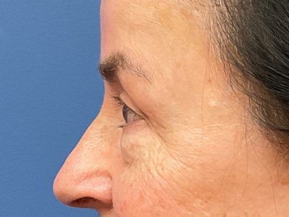Eyelid Lift Before & After