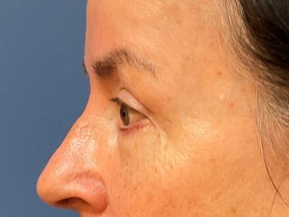 Eyelid Lift Before & After